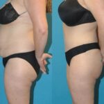 Tummy Tuck #37 - Before and After