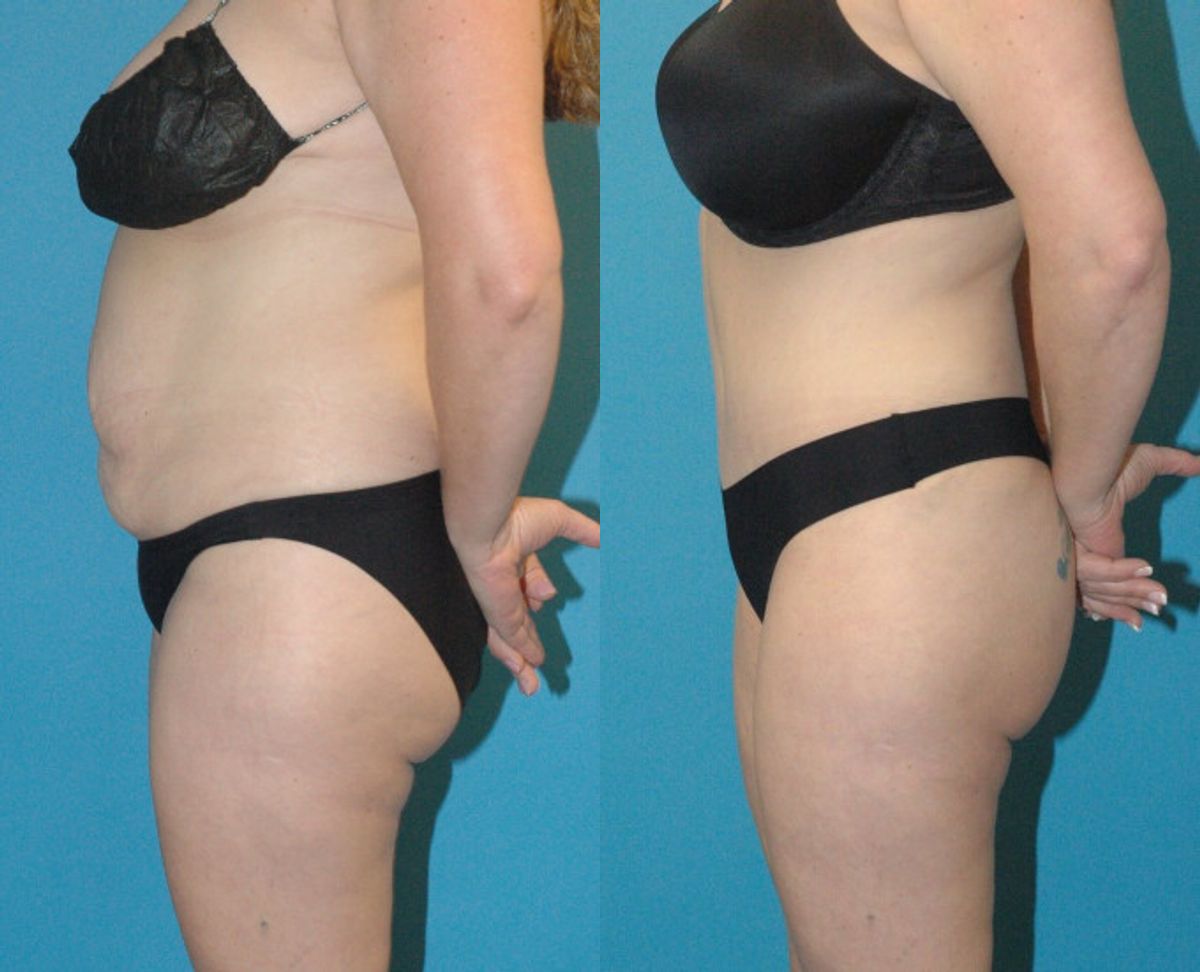 Tummy Tuck #37 - Before and After