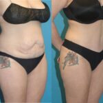 Tummy Tuck #37 - Before and After