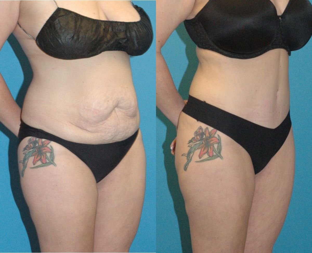 Tummy Tuck #37 - Before and After