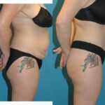 Tummy Tuck #37 - Before and After