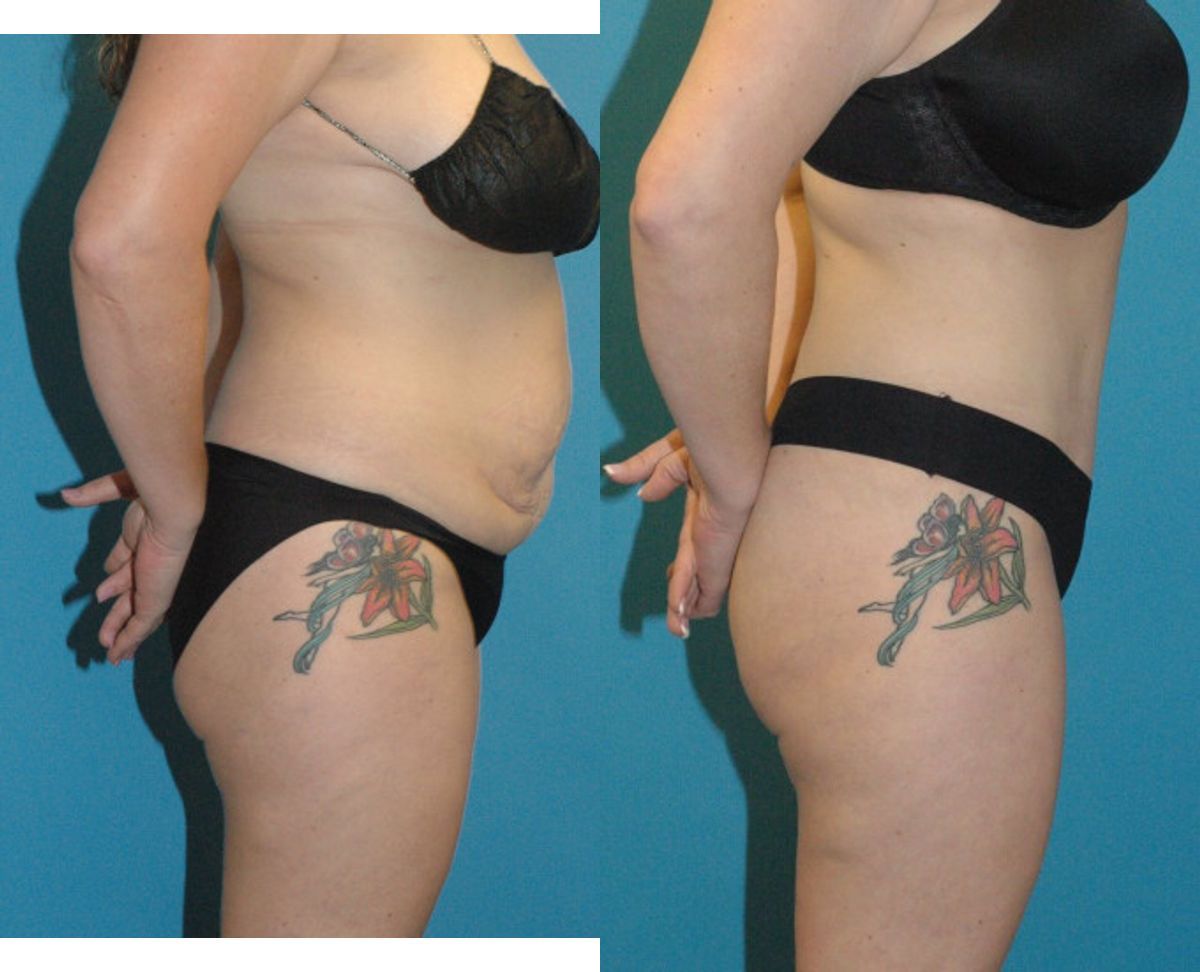 Tummy Tuck #37 - Before and After
