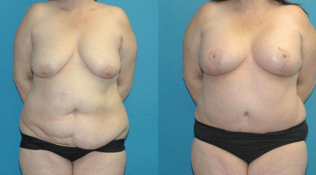 Tummy Tuck #38