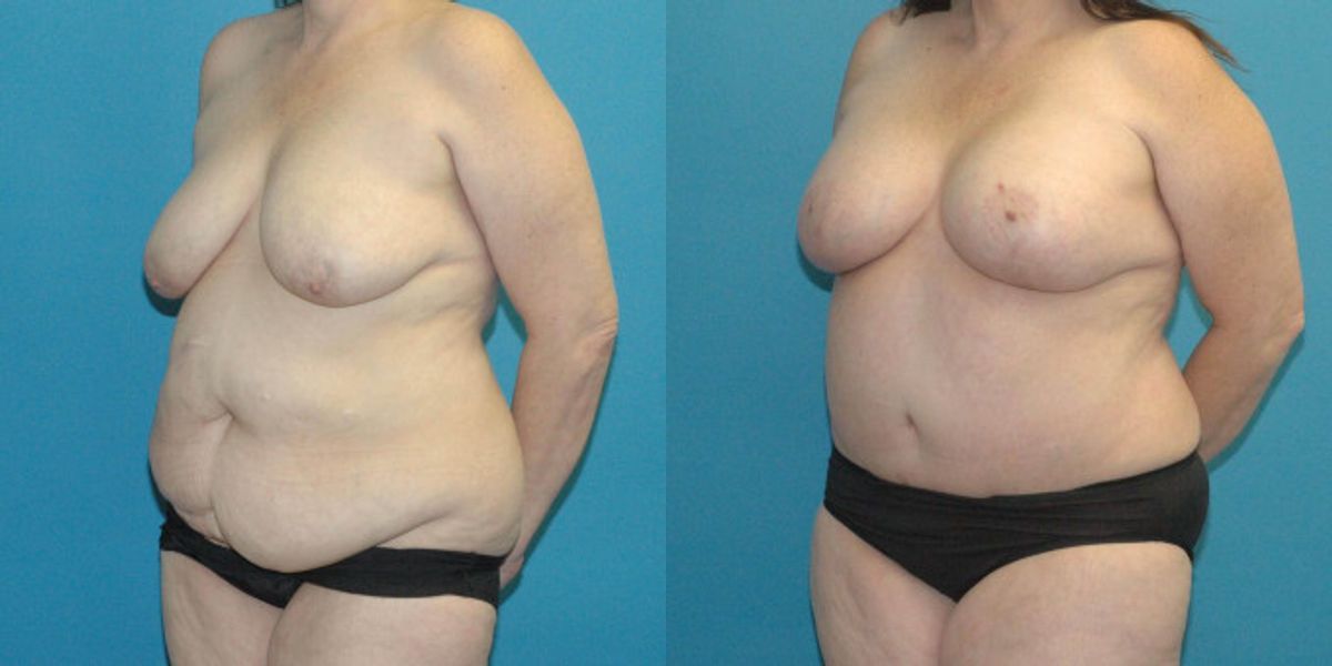 Tummy Tuck #38 - Before and After