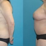 Tummy Tuck #38 - Before and After