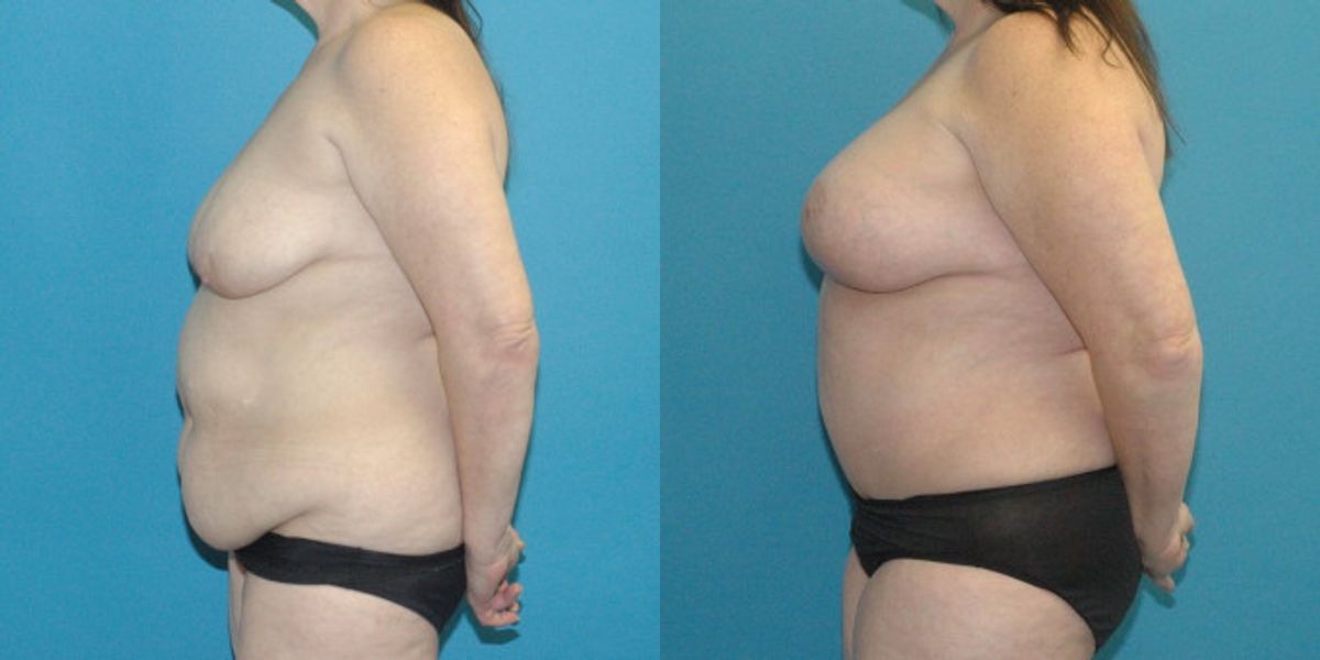 Tummy Tuck #38 - Before and After