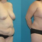 Tummy Tuck #38 - Before and After