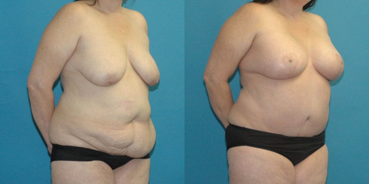 Tummy Tuck #38 - Before and After