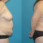 Tummy Tuck #38 - Before and After