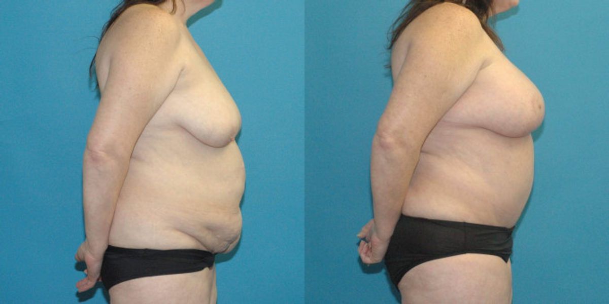 Tummy Tuck #38 - Before and After