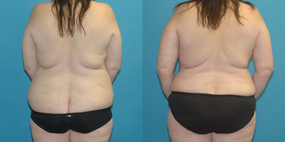 Tummy Tuck #38 - Before and After