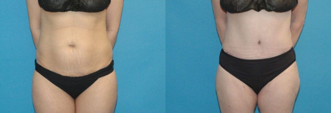 Tummy Tuck #39