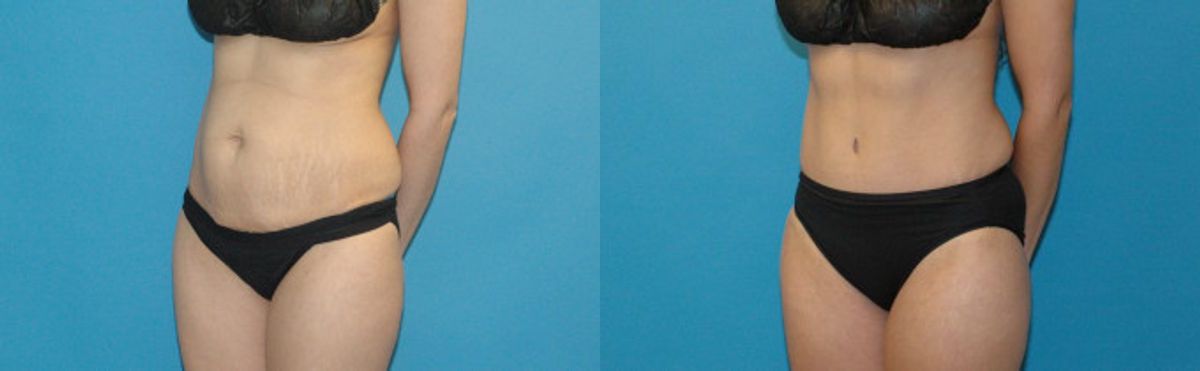 Tummy Tuck #39 - Before and After