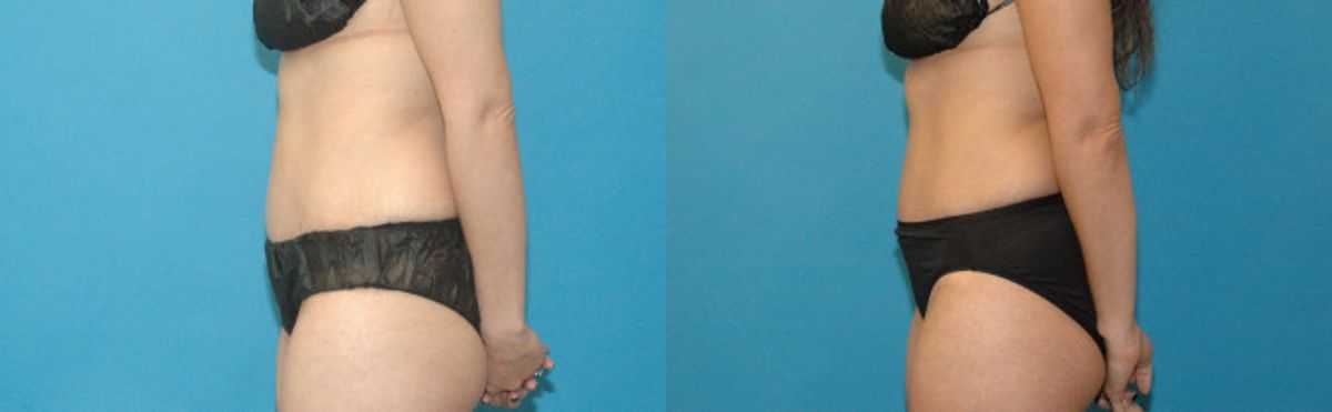 Tummy Tuck #39 - Before and After