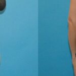 Tummy Tuck #39 - Before and After