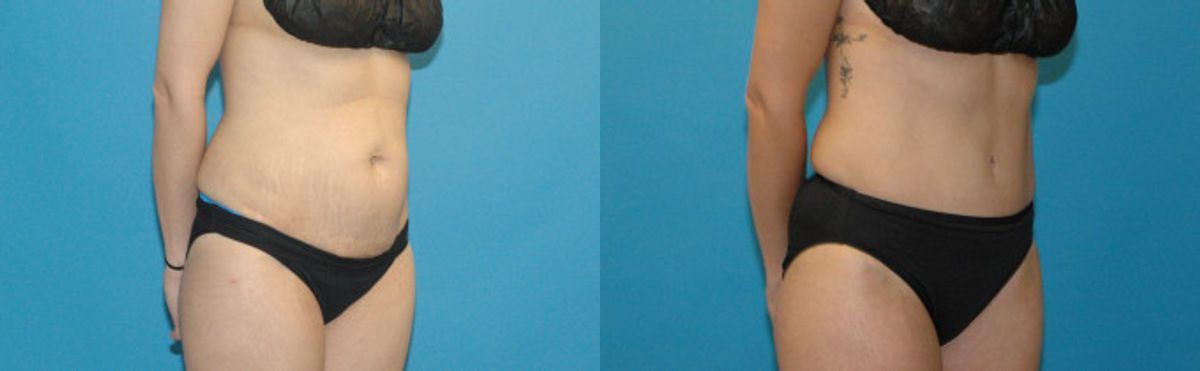 Tummy Tuck #39 - Before and After