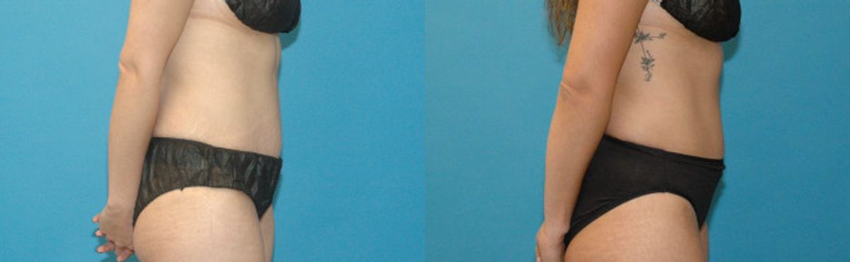 Tummy Tuck #39 - Before and After