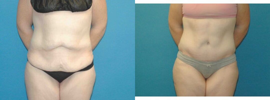 Tummy Tuck #40