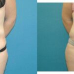 Tummy Tuck #40 - Before and After