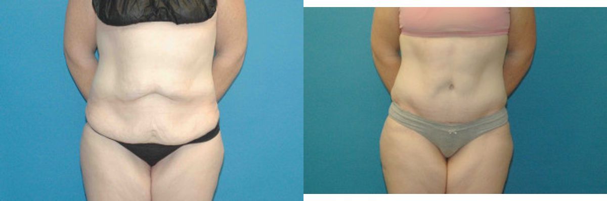 Tummy Tuck #40 - Before and After