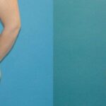 Tummy Tuck #40 - Before and After