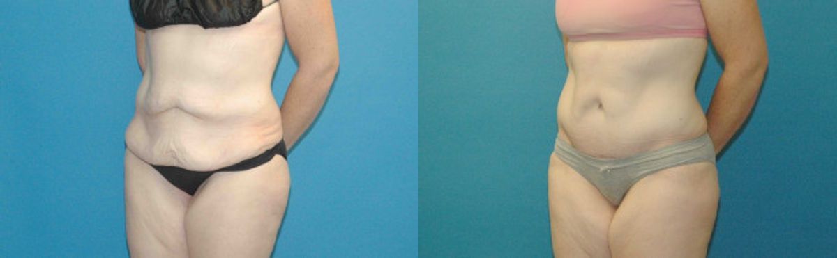 Tummy Tuck #40 - Before and After