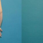 Tummy Tuck #40 - Before and After