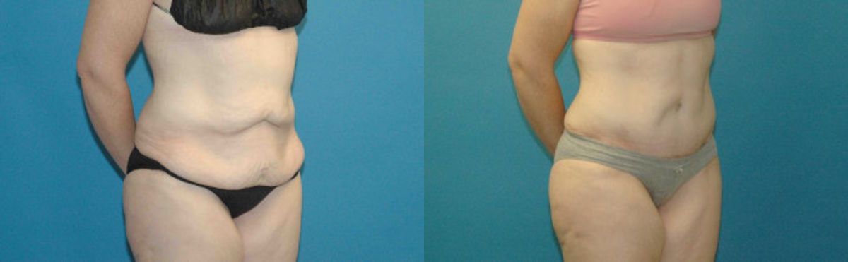 Tummy Tuck #40 - Before and After