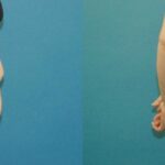 Tummy Tuck #40 - Before and After