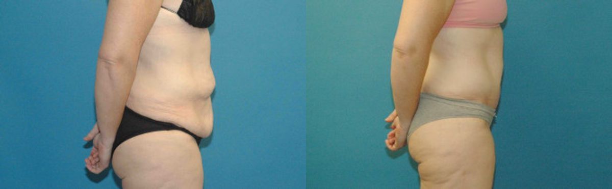 Tummy Tuck #40 - Before and After