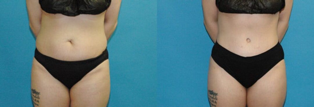 Tummy Tuck #41