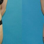 Tummy Tuck #41 - Before and After