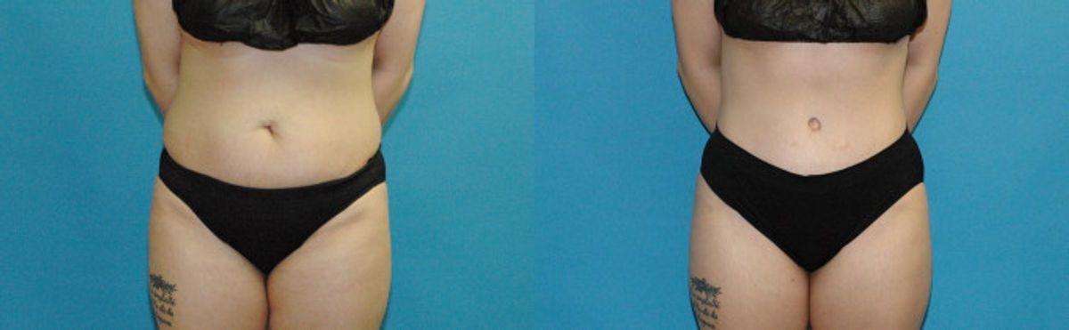 Tummy Tuck #41 - Before and After