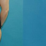 Tummy Tuck #41 - Before and After