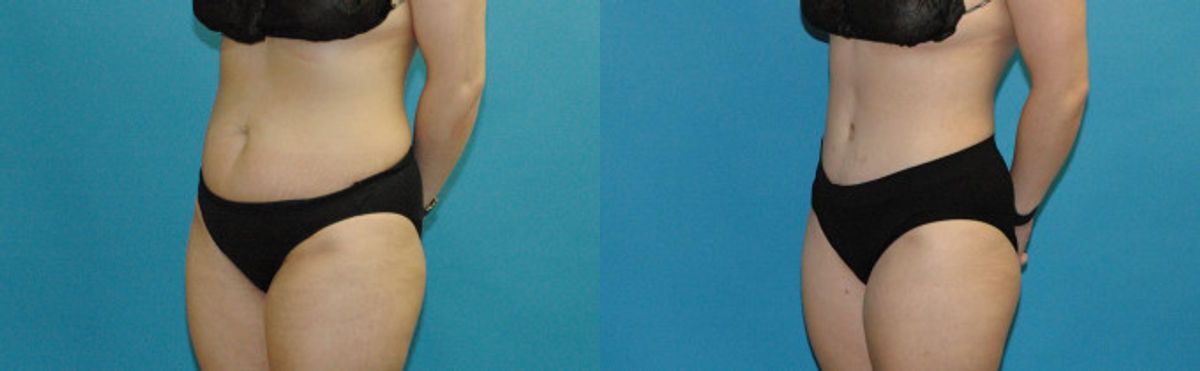 Tummy Tuck #41 - Before and After