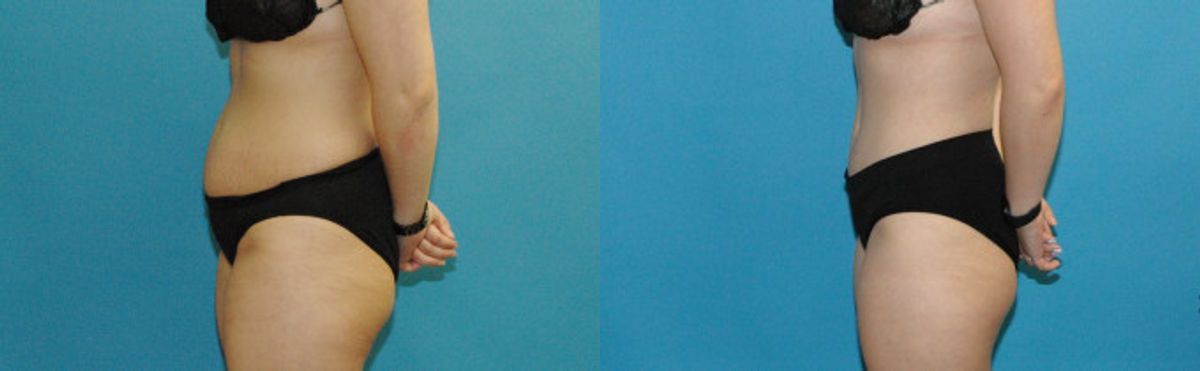 Tummy Tuck #41 - Before and After