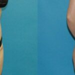 Tummy Tuck #41 - Before and After