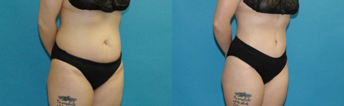Tummy Tuck #41 - Before and After