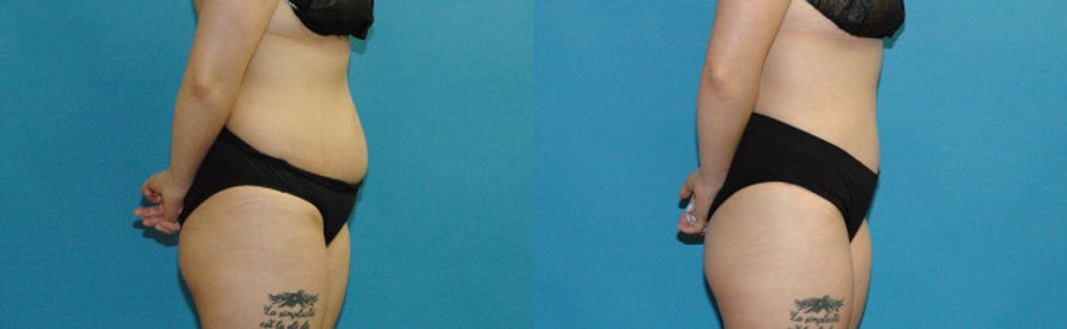 Tummy Tuck #41 - Before and After