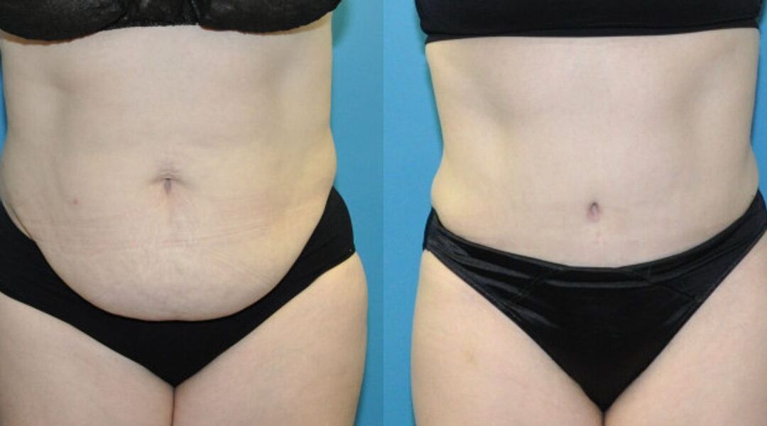 Tummy Tuck #42