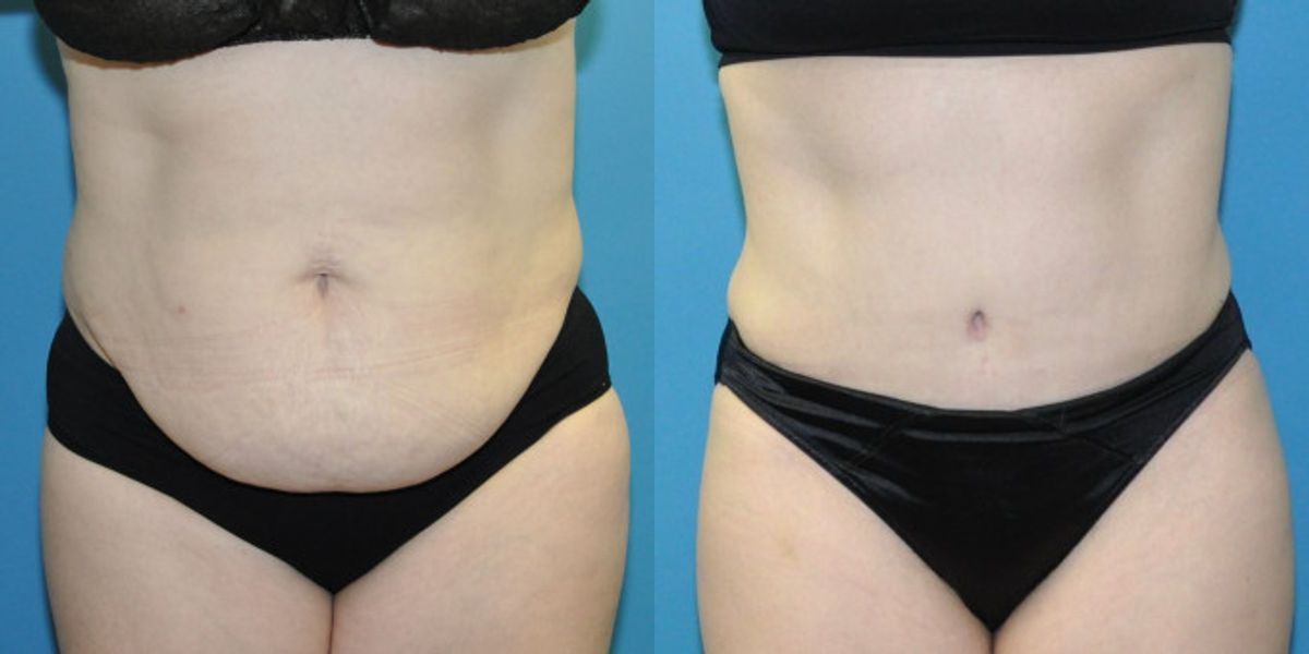 Tummy Tuck #42 - Before and After