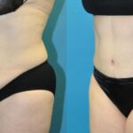 Tummy Tuck #42 - Before and After