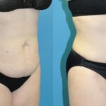 Tummy Tuck #42 - Before and After