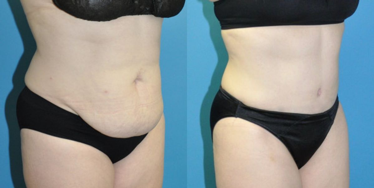Tummy Tuck #42 - Before and After