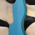 Tummy Tuck #42 - Before and After