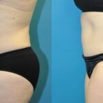 Tummy Tuck #42 - Before and After