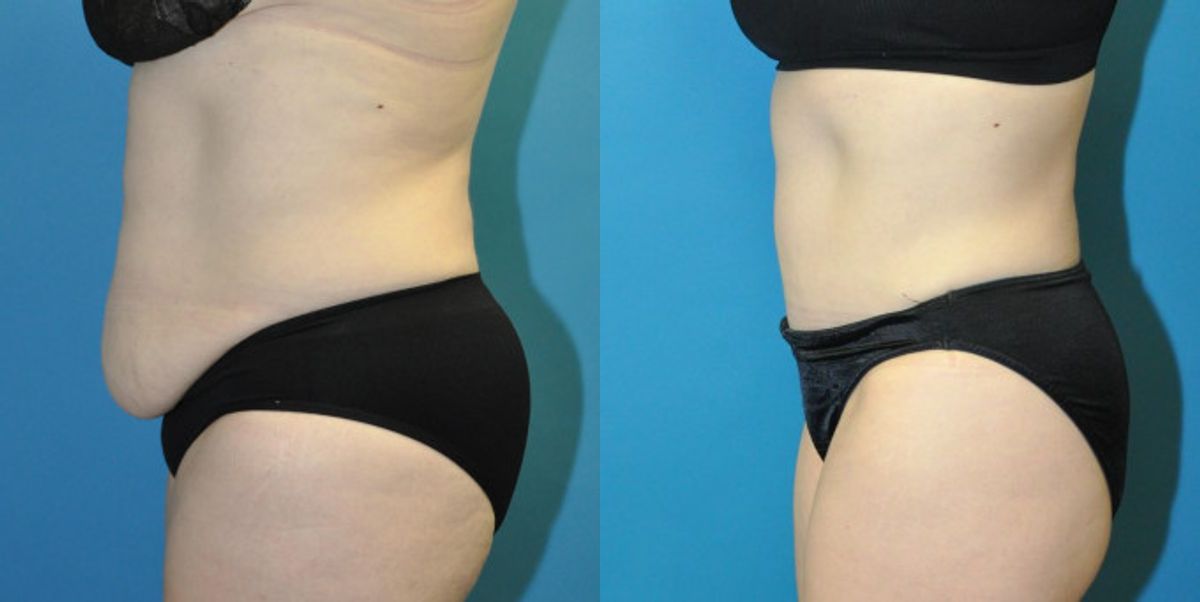 Tummy Tuck #42 - Before and After