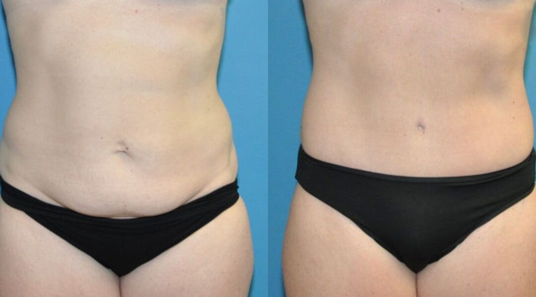 Tummy Tuck #43