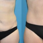 Tummy Tuck #43 - Before and After