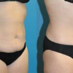 Tummy Tuck #43 - Before and After